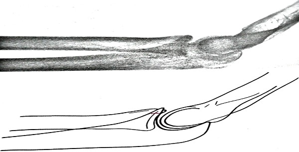 Боковой рентгеновский снимок перелома венечного отростка локтевой кости
