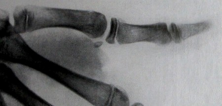 Эпифизеолиз фаланг пальцев на боковом рентгеновском снимке
