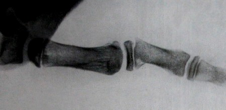Эпифизеолиз фаланг пальцев на ладонно-тыльном рентгеновском снимке