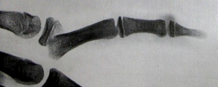 Эпифизеолиз фаланг пальцев на полном боковом снимке