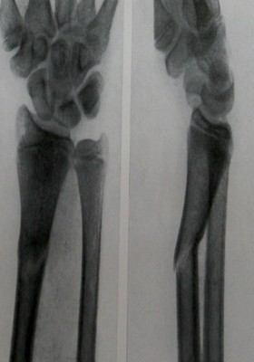 Компрессионный перелом лучевой кости у ребенка по типу «зеленой ветки»