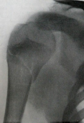 Косой перелом хирургической шейки плеча