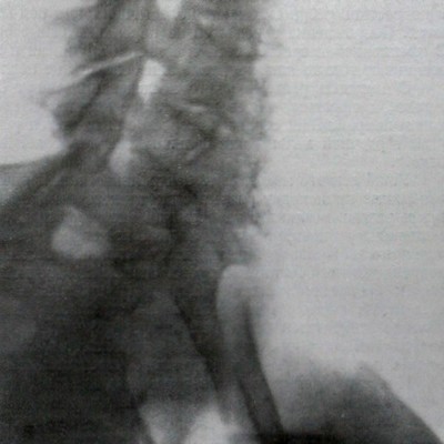 Перелом 1 ребра на косом рентгеновском снимке шейного отдела позвоночника