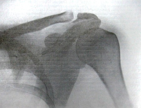 Перелом акромиального отростка лопатки на рентгеновском снимке