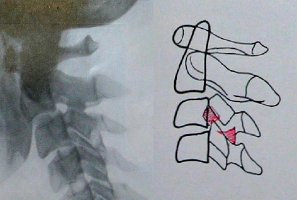 Перелом нижнего суставного отростка 3 шейного позвонка