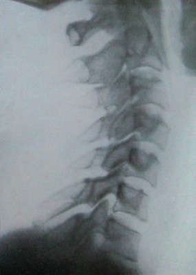 Продольный перелом остистого отростка 6 шейного позвонка