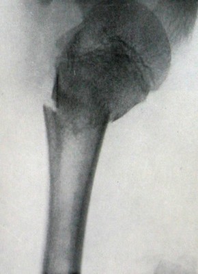 Перелом проксимального конца плечевой кости на боковом рентгеновском снимке