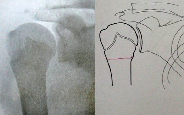 Перелом проксимального конца плечевой кости по типу «зеленой ветки» без смещения