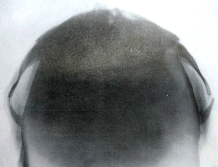 Перелом скуловой дуги на рентгеновском снимке