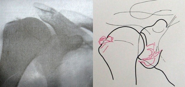 Перелом суставной ямки лопатки на рентгеновском снимке
