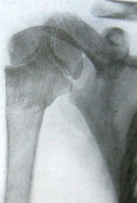Перелом у 7-летней девочки проксимального конца плечевой кости по типу «зеленой ветки»