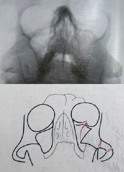 Перелом верхней челюсти и скуловой кости на рентгеновском снимке
