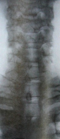 Подвывих 6 шейного позвонка на сагитальном рентгеновском снимке