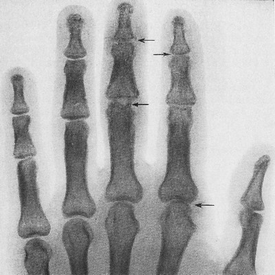Псориаз у мужчины 47 лет: сужение суставных щелей, краевая деструкция в ряде суставов кости (стрелки)