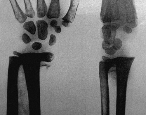 Рентгенограммы эпифизеолиза лучевой и локтевой костей