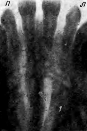 Рентгеновский снимок твердого неба (положение лежа)