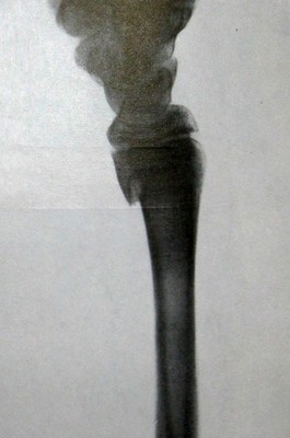 Рентгеновский снимок в боковой проекции эпифизеолиза лучевой кости у ребенка