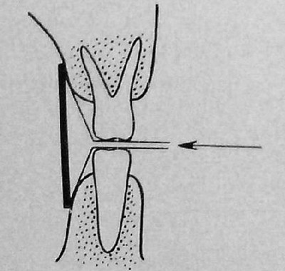 Схема положения пленки в полости рта и направления центрального пучка лучей при рентгенографии по методу Рапера