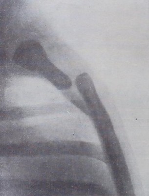 Снимок грудины в боковой проекции. Перелом на границе рукоятки и тела грудины со смещением отломков по ширине на 1,5 см.