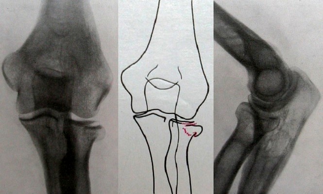 Задний и боковой рентгеновские снимки перелома головки лучевой кости