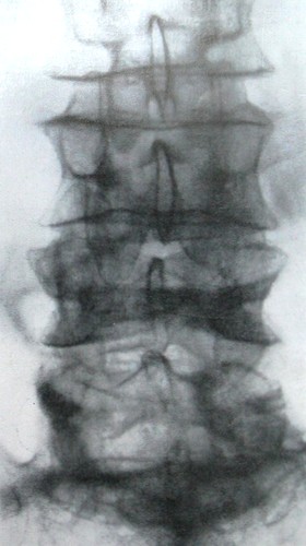 Задний рентгеновский снимок перелома 4 поясничного позвонка по продольной оси