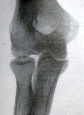 Задний рентгеновский снимок перелома головки лучевой кости