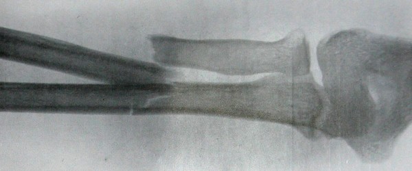 Задний рентгеновский снимок перелома предплечья на границе между верхней и средней третями