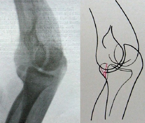 Задний рентгеновский снимок перелома венечного отростка локтевой кости