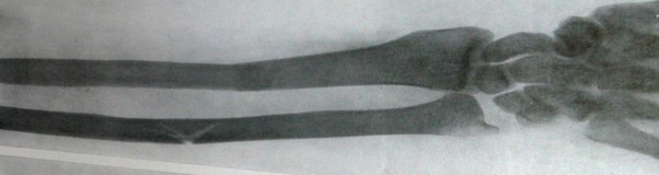 Задний рентгеновский снимок перелома предплечья на границе между средней и нижней третями