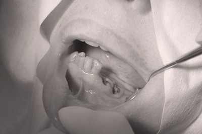 Контроль раны и ее обработка после удаления зуба
