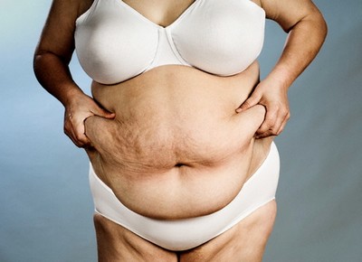 Ожирение тяжелой степени у женщины