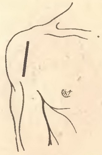 Разрез при резекции плечевого сустава по Лангенбеку