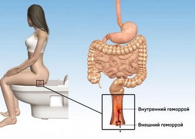 Виды геморроя: внешний и внутренний