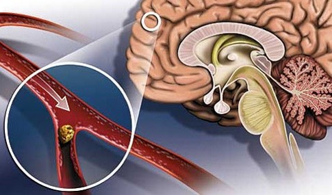 Атеросклероз сосудов головного мозга - причина бреда ревности