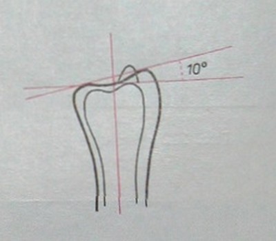 Схематическое изображение угла наклона проксимальной плоскости лучезапястного сустава на боковом снимке