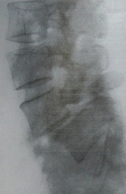Рентгеновский снимок перелома pars interarticularis 4 поясничного позвонка с вывихом в боковой проекции