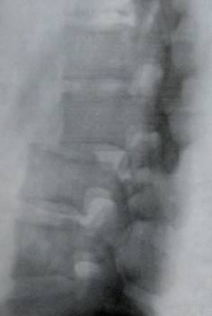 Рентгеновский снимок переломо-вывиха 2 и 3 поясничных позвонков в боковой проекции