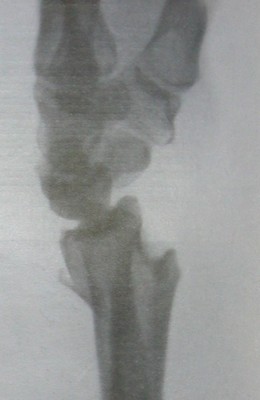 Рентгеновский снимок типичного перелома лучевой кости со смещением в боковой проекции