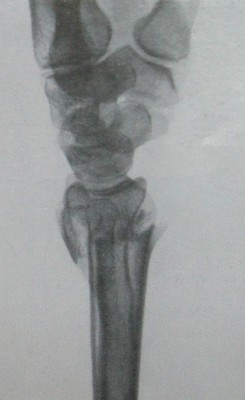 Рентгеновский снимок перелома в нижней трети костей предплечья в боковой проекции