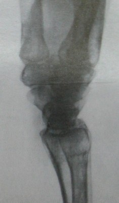 Рентгеновский снимок типичного перелома лучевой кости без смещения в боковой проекции
