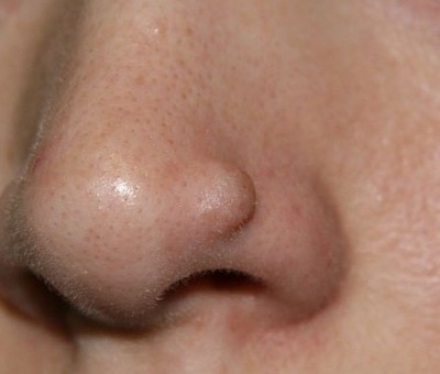Фибромиома кожи с локализацией на носу