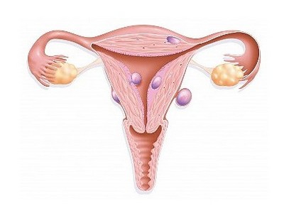Фибромиома матки и ее лечение