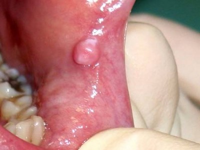 Фибромы слизистых оболочек рта