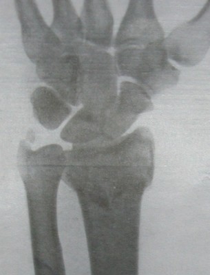 Рентгеновский снимок типичного перелома лучевой кости со смещением в ладонной проекции