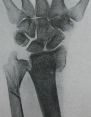 Рентгеновский снимок перелома в нижней трети костей предплечья в ладонной проекции