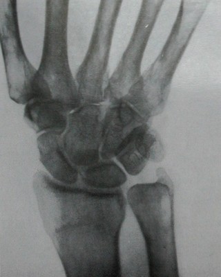 Рентгеновский снимок типичного перелома лучевой кости без смещения в ладонной проекции