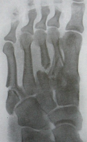 Косой рентгеновский снимок оскольчатого перелома II-V плюсневых костей