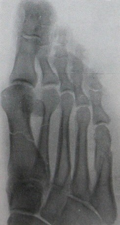 Косой снимок оскольчатого перелома II-V плюсневых костей