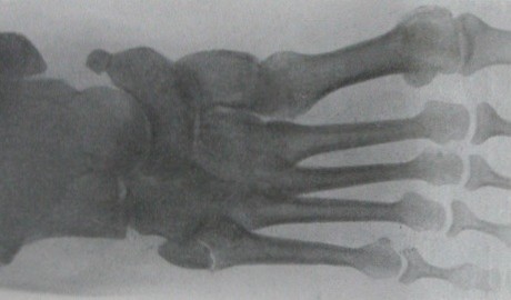 Тыльно-подошвенный рентгеновский снимок отрыва основания V плюсневой кости