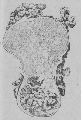 Папиллярная (серозная) киста яичника